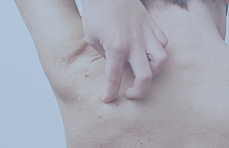 アトピー性皮膚炎